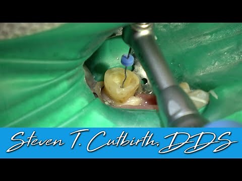 Root Canal and Crowns on Mandibular Molar and Bicuspid - with Dr. Steven T. Cutbirth, DDS