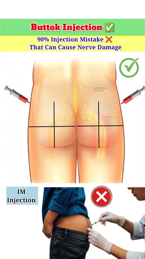 90% People Inject at the Wrong Site ❌ | IM Injection Mistake