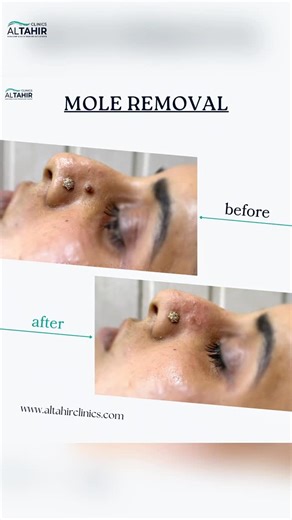 𝑫𝒓 𝑲𝒂𝒏𝒘𝒂𝒍 𝑱𝒂𝒕𝒐𝒊 on Instagram: "✨ Say Goodbye to Moles — Without Scars! ✨ At Al Tahir Clinic, we offer advanced mole removal treatments that are: ✔️ Safe ✔️ Quick ✔️ Scar-free ✔️ Performed by professionals No stitches. No long recovery. Just clear, confident skin 💫 📍 Visit Al Tahir Clinic 📞 0300 8884312 📲 Book your consultation today! Your skin deserves expert care ✨ #MoleRemoval #ScarFreeSkin #SkinCareClinic #AlTahirClinic #AestheticTreatment #ClearSkin #DermatologyCare #SkinCon