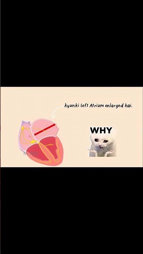 Left Ventricular Hypertrophy (LVH) – ECG Changes Explained 🫀📊