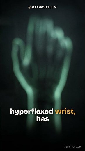 De Quervain's Disease: Finkelstein Test & WHAT Test Explained