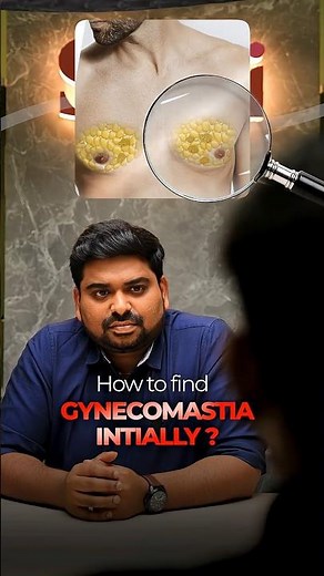 Home test to check true gynecomastia - "The Pinch Test"
