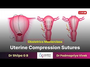 Obstetrics Masterclass- Uterine Compression Sutures | Shilpa G B | PadmaPriya Vivek