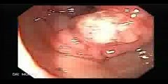 Colonoscopy displaying a Colon Cancer