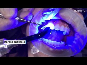 Carriere MOTION 3D CLEAR Class II Bonding | Dr Paquette & Henry Schein Orthodontics