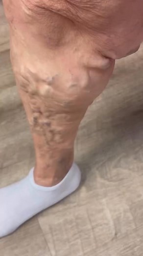 91K views · 264 reactions | Look at these results ! A technique using...