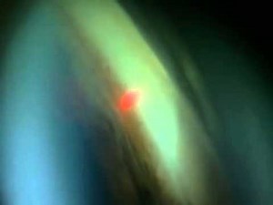 Selective Laser Trabeculoplasty