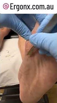 Ultimate Forefoot Callus Removal Secrets Revealed #PodiatryTips #FootCare