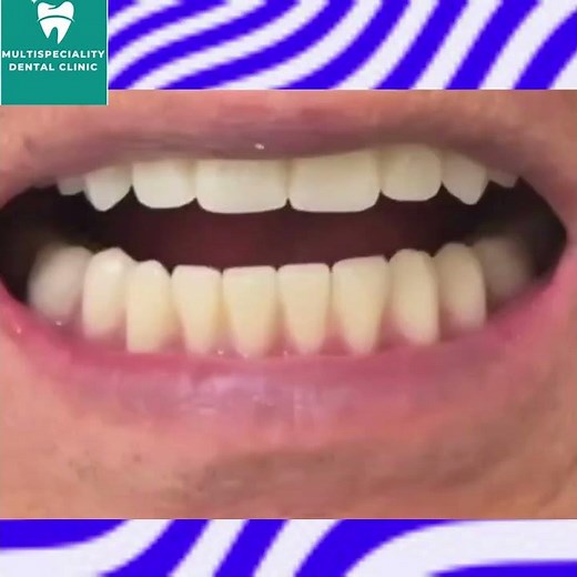 NEW COMPLETE DENTURE