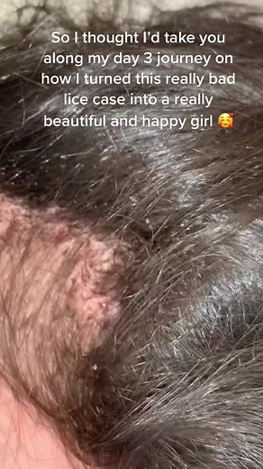 Like nearly 8 hours of work ? Lmk what you think ? 💪🏼 #licetok #satisfying #licepopping #headlice #trashywashyy