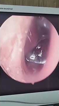Professional Ear Canal Cleaning | Educational Procedure