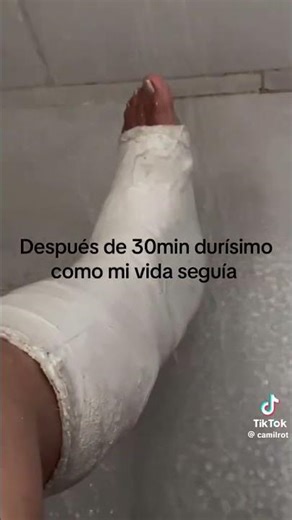 Leg cast Removal at home