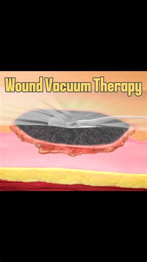 Vetventures on Instagram: "Wound Vacuum Therapy 🤯 Use code Vetventures to get 10% off @thesuturebuddy suture kits! Disclaimer: This is not an appropriate therapy for all wound types. See all disclaimers through link in bio #doctorsofinstagram #veterinariansofinstagram #surgeonsofinstagram #surgery #medicine #nursesofinstagram #vetsofinstsgram #hacks #medicalinstagram #vet"