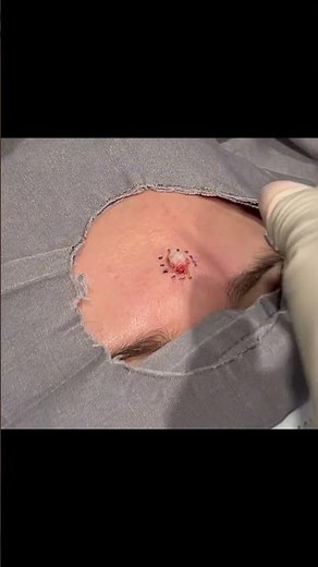 Marshmellow Cyst!