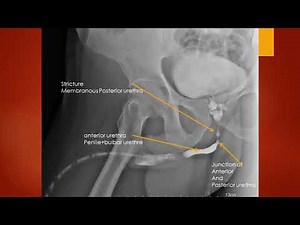 CASE 505 ascending retrograge urethrography stricture posterior memberanous posterior urethra