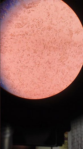 "Urine RBC under Microscope 🔬 | Microscopic View of Red Blood Cells in Urine | Pathology Lab Test"