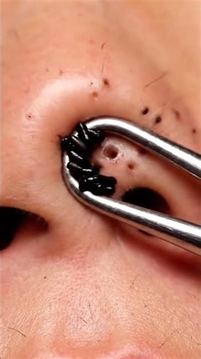 Relax Every Day, Spa Facial Treatment, Blackhead Extraction, Whitehead Removal,ASMR, Relaxing Spa#1