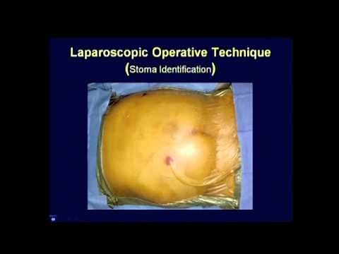 Parastomal Hernia Repair � Best Techniques: Kristi Harold, M.D.