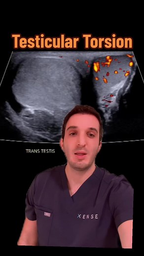 Understanding Testicular Torsion: Symptoms and Diagnosis