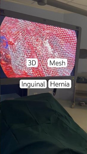 3D Mesh | 3D NET I Hernia Net I Hernia Mesh I Laparoscopic Inguinal Hernioplasty