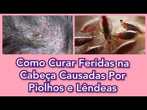 Como Tratar Feridas Causadas Por Infestação de Piolhos e Lêndeas - Curar Feridas na Cabeça - Piolhos