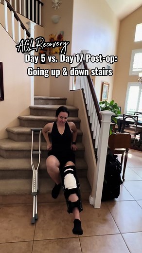 Meniscus Surgery Recovery Progress: Walking with Crutches | ACL Physical Therapy