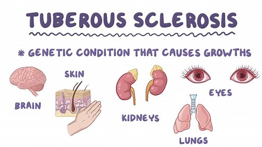 Video: Tuberous sclerosis - Video Explanation! | Osmosis | Osmosis
