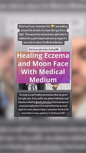 21K views · 278 reactions | Healing Eczema and Moon Face With Medical...