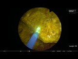 Bladder Stone Lithotripsy with Pulsed Thulium YAG Laser • Video • MEDtube.net