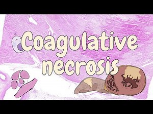 Coagulative necrosis - general pathology