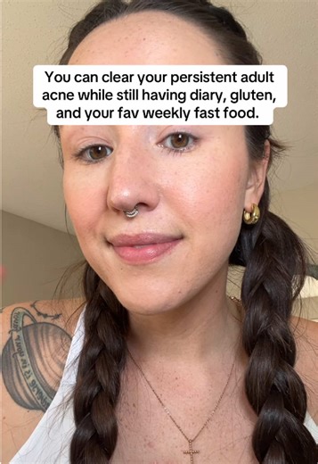 In the ISS we will clear your adult acne without meds, cutting out foods, or a long list of testing/supplements. This is the way clearing your acne SHOULD BE 🤌🏼. #acne #adultacne #clearskin