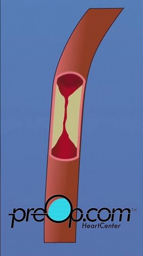 🔍 PreOp® Coronary Artery Bypass Graft (CABG) On Pump 💡 What “On-Pump” Means