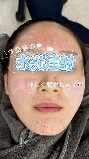 今話題の水光注射って！？詳しくは【水光 jskin】で検索🔍 #美容皮膚科 #水光肌 #水光注射 #美肌 #肌管理