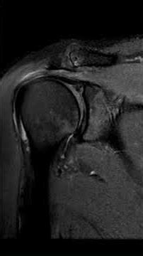 Shoulder MRI: Don’t Miss Denervation Changes#MSK#Radiology #MRI #shoulder#athlete#pain#trauma