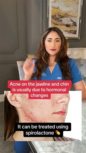 Life hacks i learned as a pharmacist! How to treat hormonal acne on the chin and jawline, how to