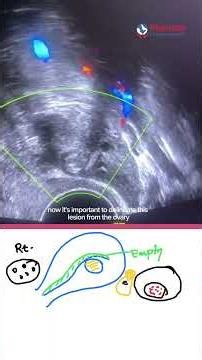 Pregnancy Of Unknown Location: Ultrasound Finding You Should Not Miss! | Mamata Fertility Hospital