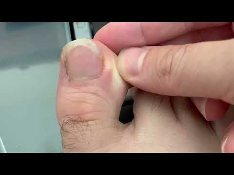 Ingrown Toenail Home Remedy Treatment