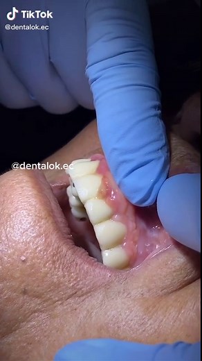 Drenaje de Absceso Periodontal: Cura y Tratamiento | Odontología de Emergencia