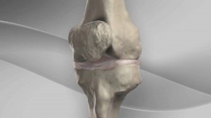 Partial Meniscectomy