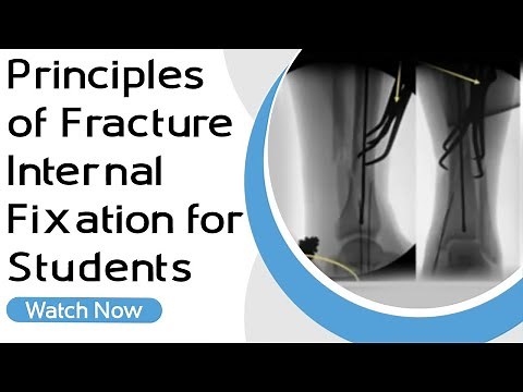 Principles of Fracture Internal Fixation for Students • Video • MEDtube.net