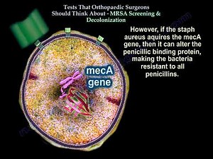 MRSA Carrier Screening and Decolonization Before Surgery