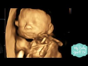 Michelle's 24 week 3D Ultrasound