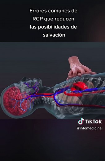 Errores Comunes de RCP: Descubre Cómo Aumentar las Posibilidades de Salvación