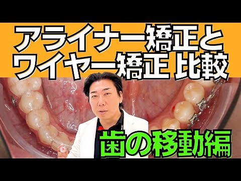 アライナー矯正とワイヤー矯正の歯の動かし方の違いについて解説します
