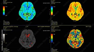 CT Brain Perfusion or CT scan image of the brain 3d rendering image analyzing cerebral blood flow on the monitor.
