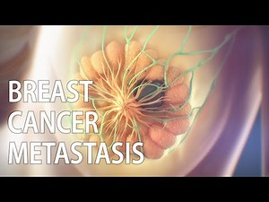 Breast cancer metastasis animation | spread of cancer | medical animation