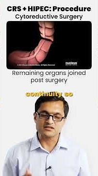 CRS + HIPEC: The procedure explained #crs #cytoreductivesurgery #hipec #cancer #cancertreatment