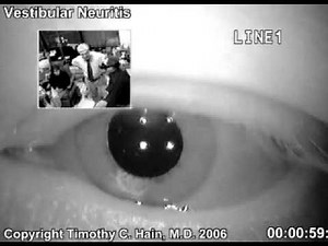 Nystagmus / Vestibular Neuritis