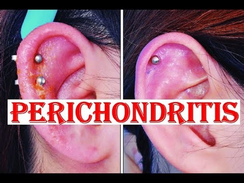 Perichondritis