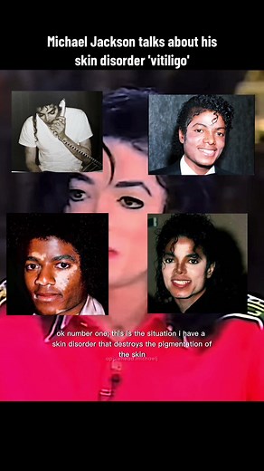 Michael Jackson Explains Vitiligo: A Skin Disorder He Could Not Control